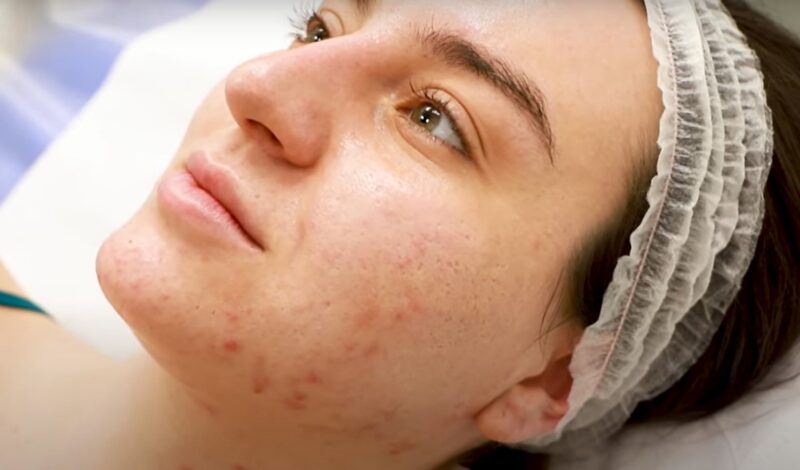 acne surgery